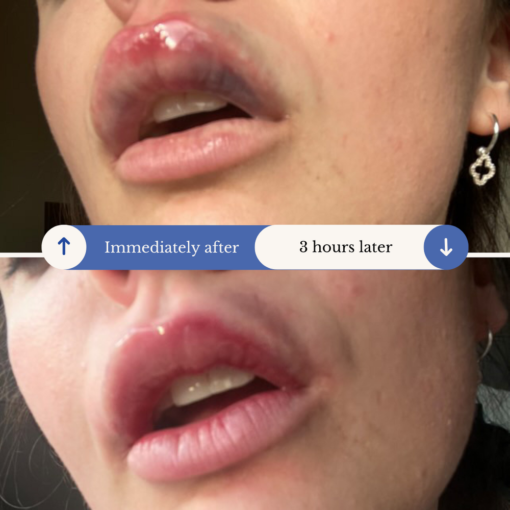 AfterMED LIPS